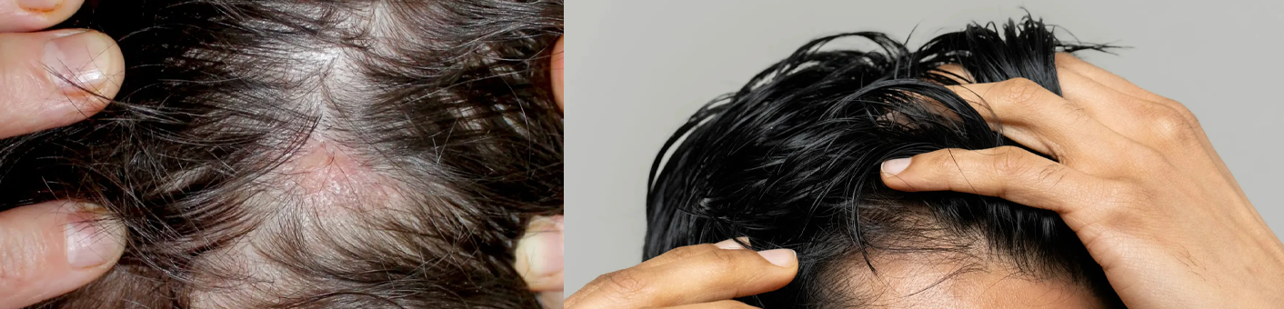 Causes, Effects and Solutions of Hair Loss _ Xyon Health